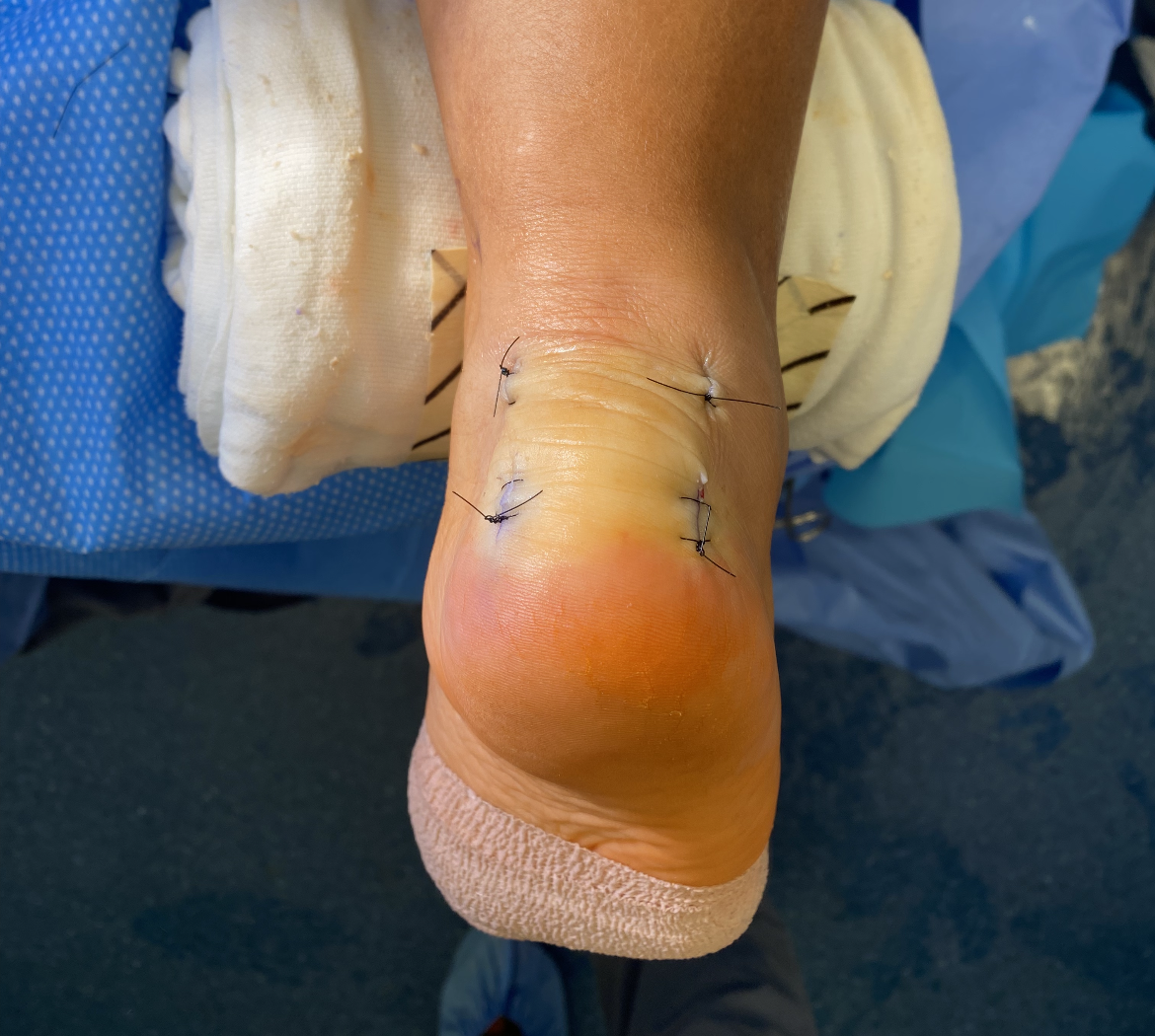 Xray before and after and skin incision