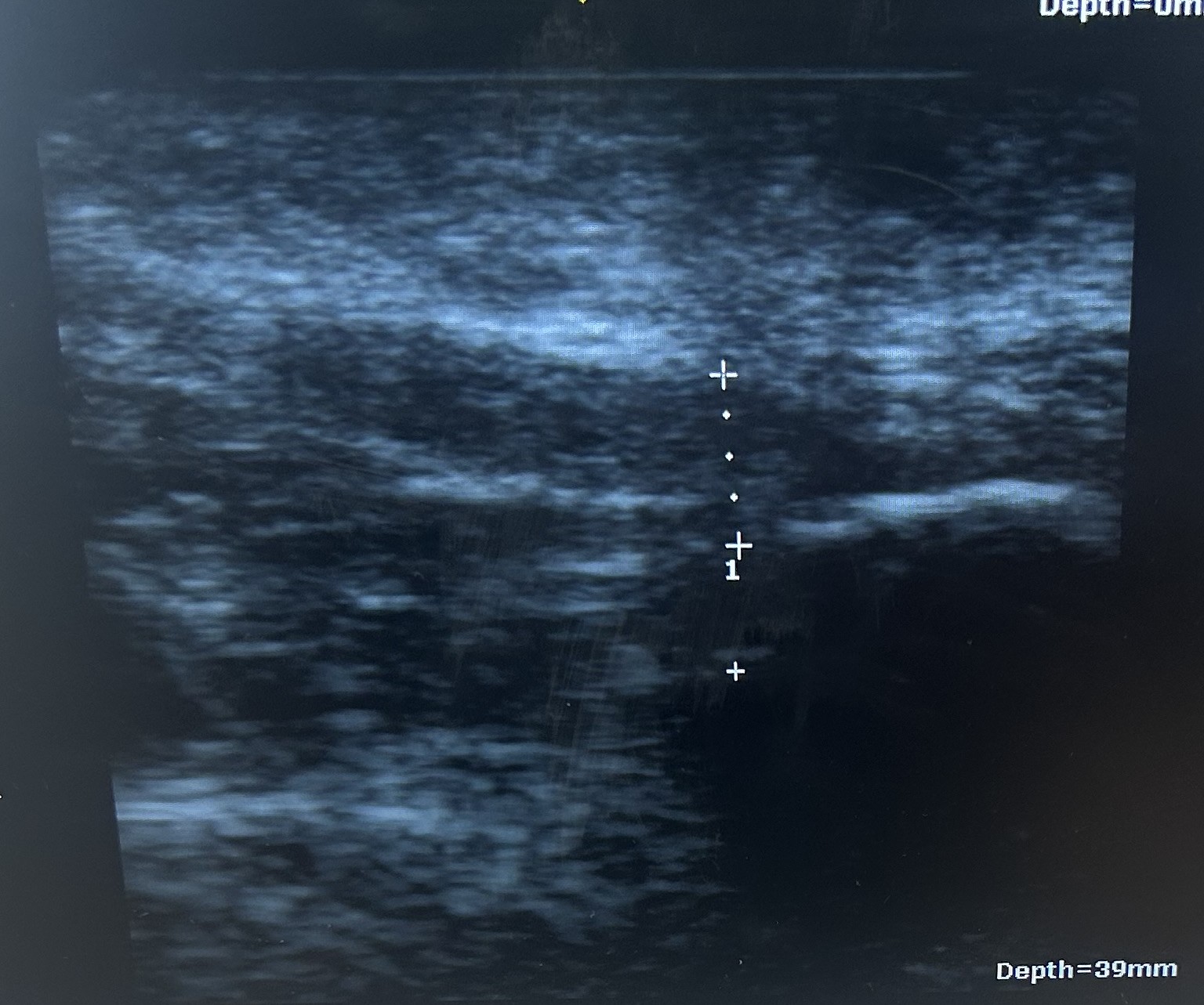 Image from ultrasound showing a thickened plantar fascia