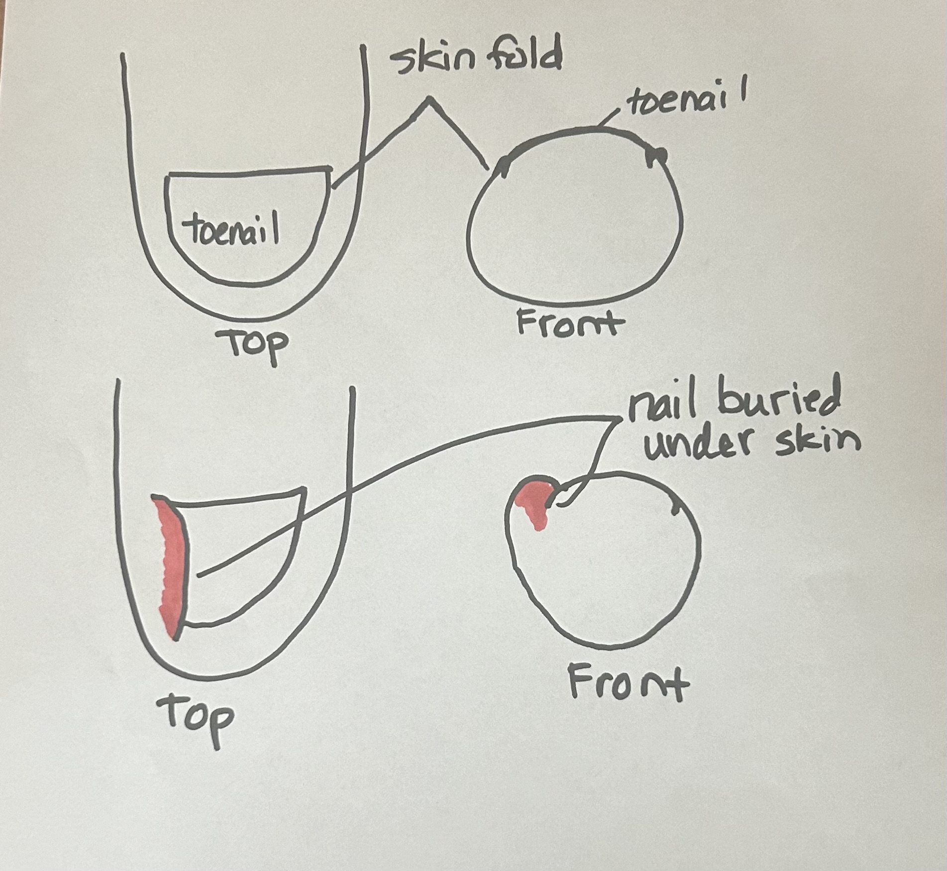 RESOLVE INGROWN TOENAILS WITHOUT SHOTS!   ONYFIX NAIL CORRECTION