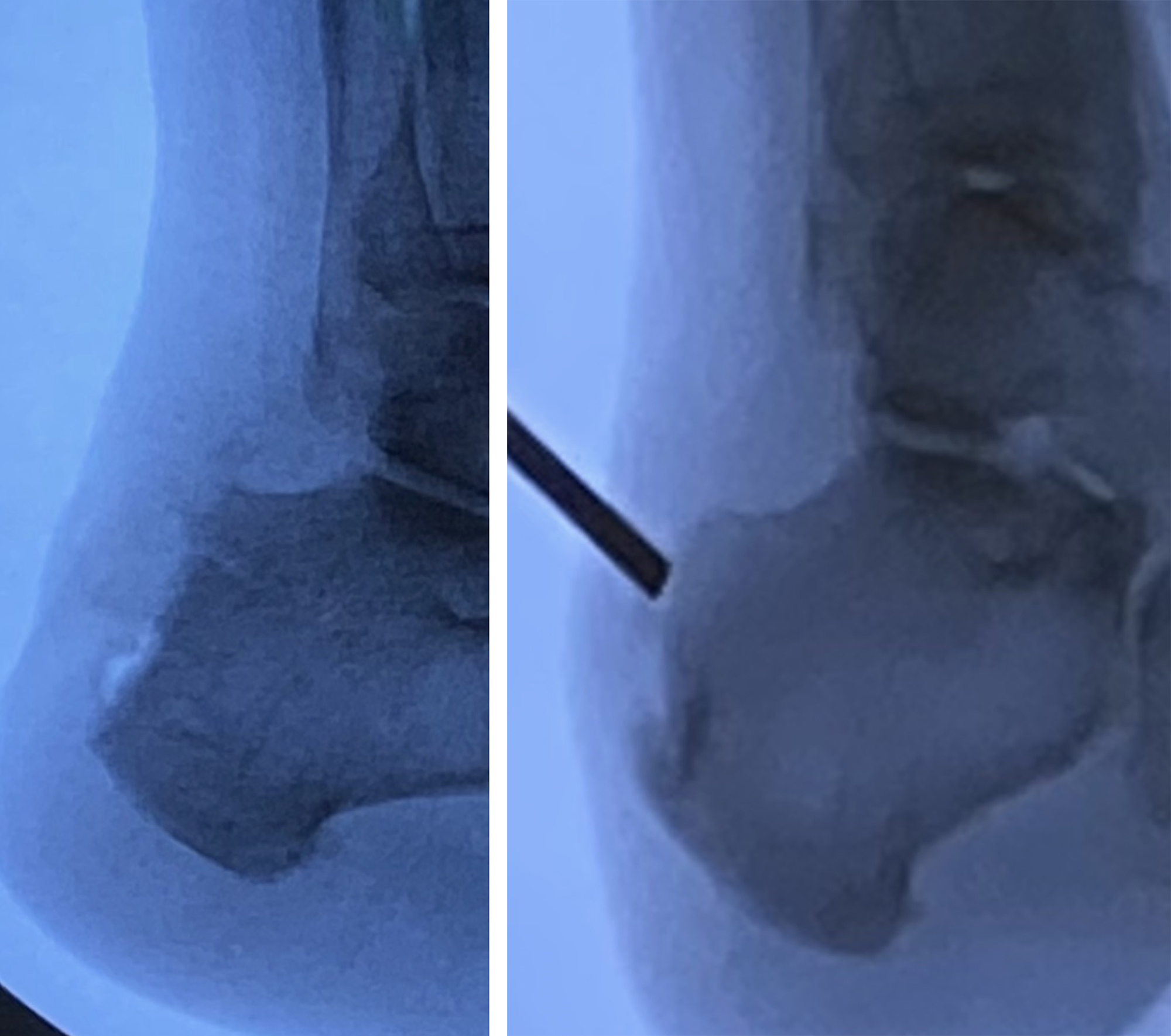 Innovation Update Minimal Invasive Achilles Surgery